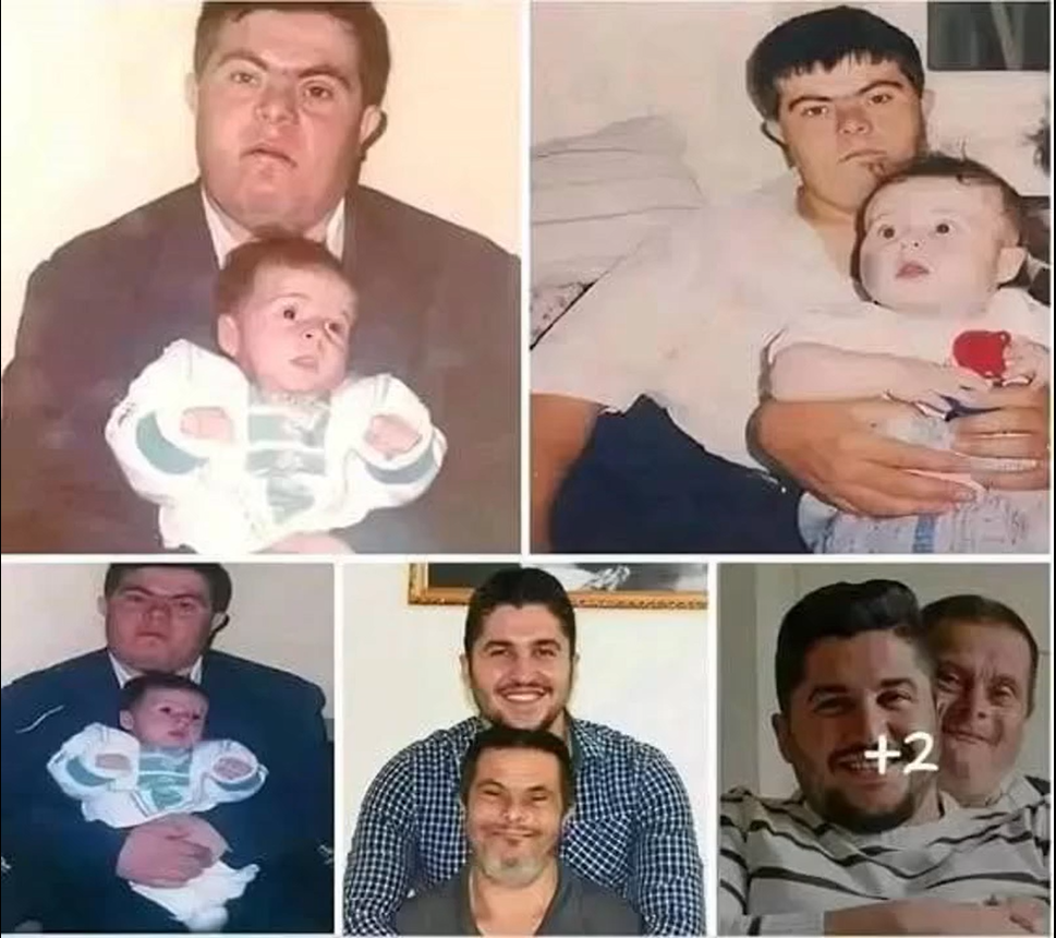Father With Down Syndrome Raises Son Who Becomes a Doctor – A Story of Love and Perseverance
