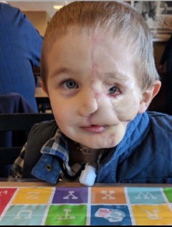 Ryder, 5, Survives Dog Attack and Inspires the World with His Courage