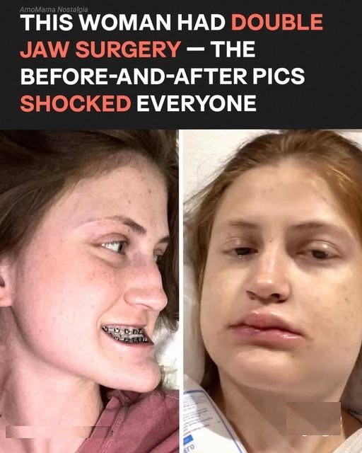 This Girl’s Double Jaw Surgery Transformation Left Millions Speechless