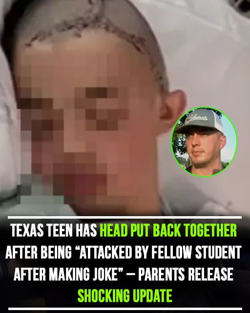 Texas Teen Suffers Skull Injuries After Alleged School Attack Over “Joke”