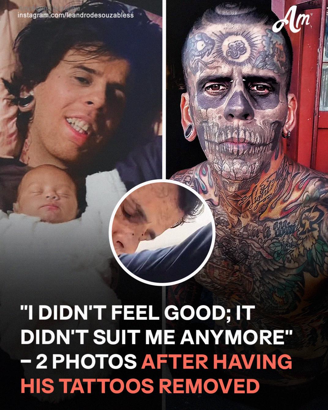 A Man Once Known for Having the Most Tattoos in Brazil Reveals His Shocking Transformation After Removing Them