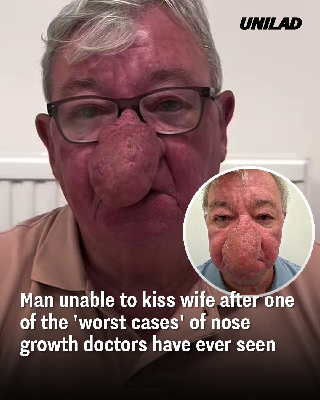 Scottish Man’s Nose Wouldn’t Stop Growing — Doctors Call It One of the Worst Cases They’ve Ever Seen